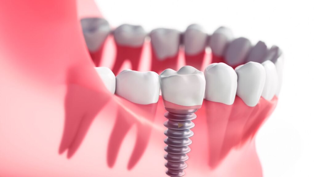 How Much Do Dental Implants Cost in London?